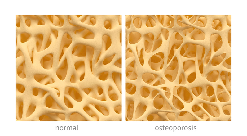 normal yapıda ve osteoporozda yapıya sahip kemik